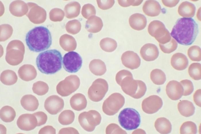 La leucemia mieloide, enfermedad que afecta a cinco mil jÃ³venes al aÃ±o