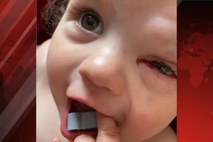 La extraña enfermedad que hace que una bebé llore sangre