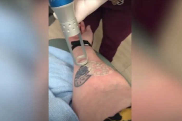 Decide quitarse el tatuaje de su adolescencia y los internautas se impactaron con las imágenes