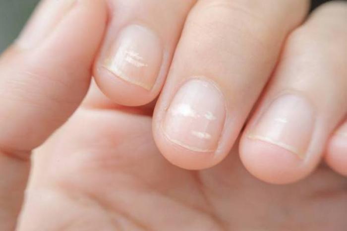 ¿Por qué salen manchas blancas en las uñas?