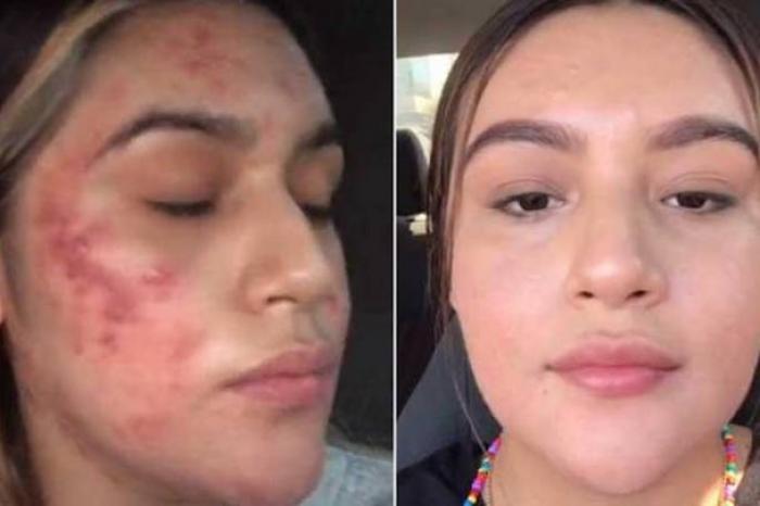 Joven comparte antes y después en su lucha contra el acné; video incendia TikTok