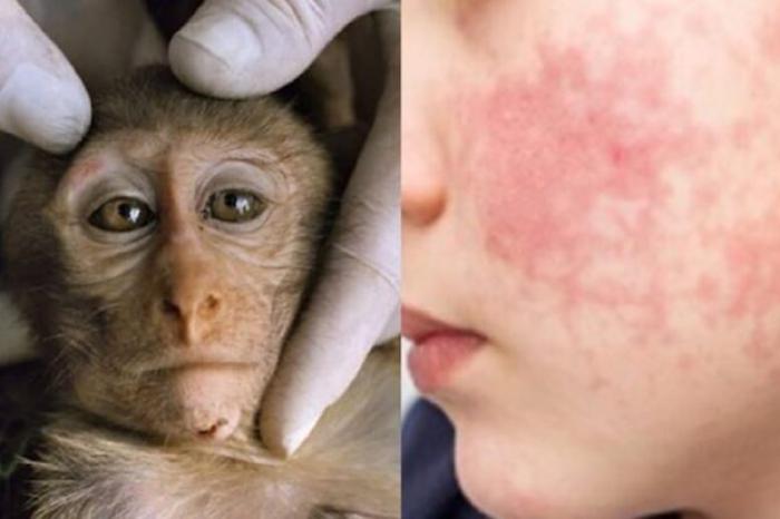 Confirma EU primer caso de viruela del mono 