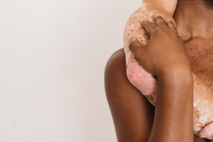 La FDA aprueba tratamiento tópico para el vitíligo no segmentario 