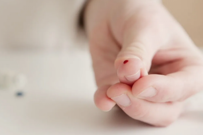 Xerosis: Una afección en la piel que podría ser provocada a causa de la diabetes