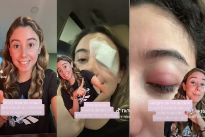 Joven es operada del ojo por probar un truco de belleza en Tiktok