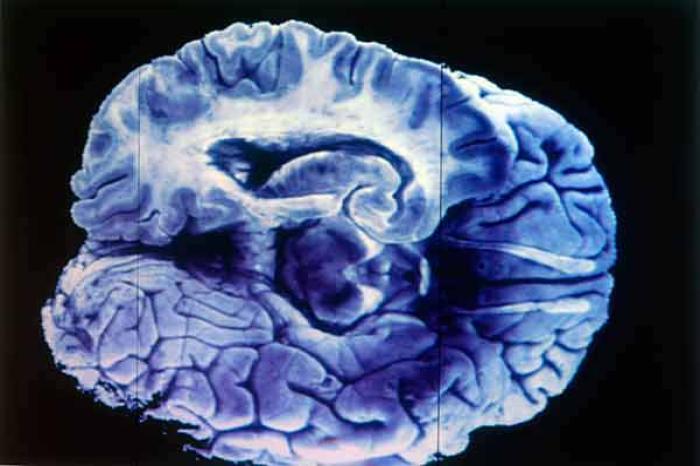 Alzheimer, enfermedad generada por hasta 20 años de daños en el cerebro