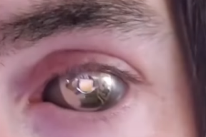 ¡Ojo biónico! Hombre transforma su pérdida por cáncer en una prótesis futurista