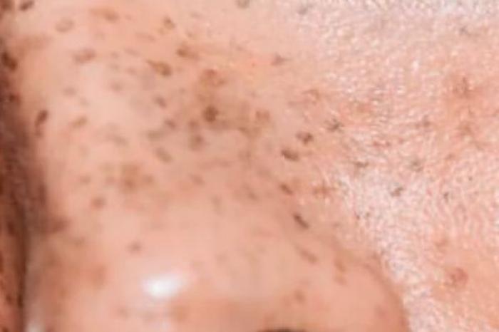 Pecas: ¿marcas inofensivas o señales de adv