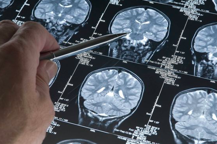 ¿El estrés puede aumentar riesgo de Alzheim
