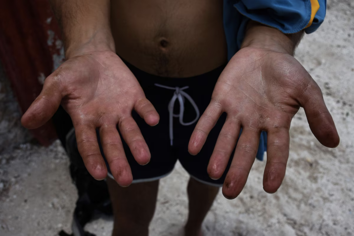 Manchas oscuras en manos podrían alertar sobre cáncer: lo que se sabe del melanoma acral