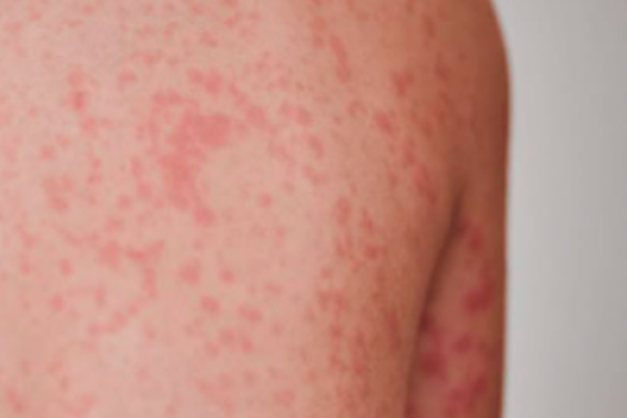 Nuevo León suma 38 casos confirmados de sarampión en 2026