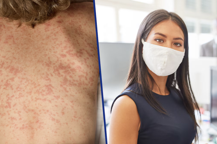 Cubrebocas aporta poco frente al sarampión, señala subsecretario